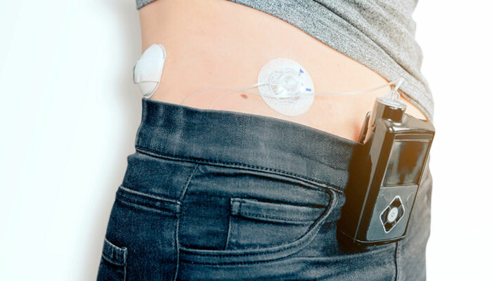 Insulin pumps – 3 best devices to buy in 2021
